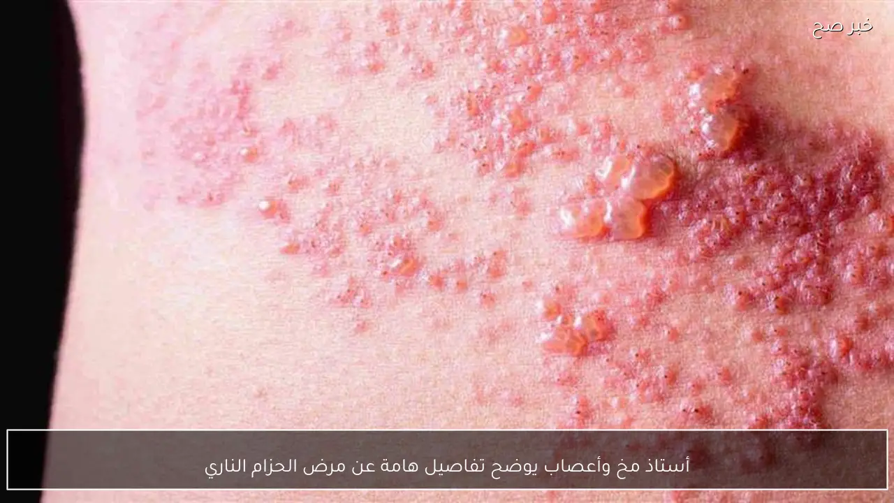 أستاذ مخ وأعصاب يوضح تفاصيل هامة عن مرض الحزام الناري